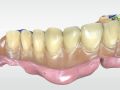 Reference Denture 1 - Capturing Records