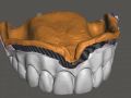 Reference Denture 2 - Creating the Virtual Pour