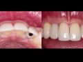 The Congenitally Missing Lateral Incisor - Part 6