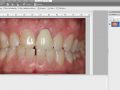 Smile Design - Two Central Incisors - Part 1