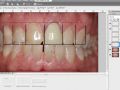 Smile Design - Two Central Incisors - Part 2