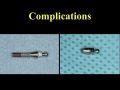 The Application of Transitional Implants in Reconstructive Dentistry - Part 6