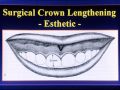 The Application of Periodontal Plastic Surgery in Esthetic Implant Dentistry - Part 6