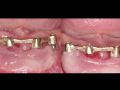 How to Remove Failing Osseointegrated Dental Implants - Part 6
