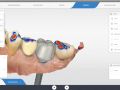 Smooth Implant Abutment