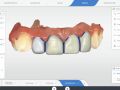Anterior 4 Tooth Design Help
