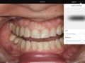 3. iPad Pro Pixelmator - Whitening Teeth