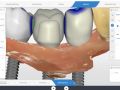 Multiple Contacts for Implant Crowns