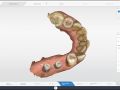 Help with Implant Design Using Morphology