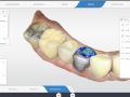 Emergence Problem Mesial Concavity Solution